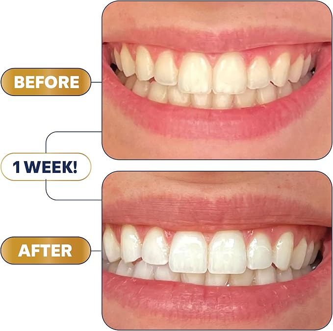 Lumineux Teeth Whitening Strips Kit